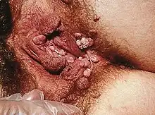 Severe case of external genital warts on a female