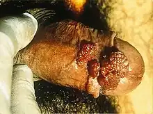 Severe case of genital warts on a male