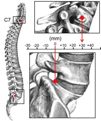 Sagittal balance measurement.[7]