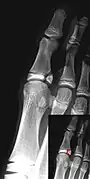 Salter–Harris IV fracture of big toe proximal phalanx.