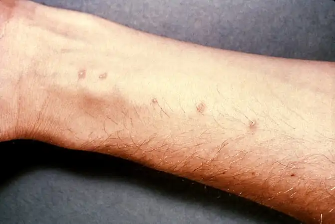 Skin blisters on the forearm, created by the entrance of Schistosoma parasites