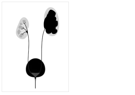 Pelvi-ureteric junction obstruction - easily mistaken for cystic renal disease on early scans