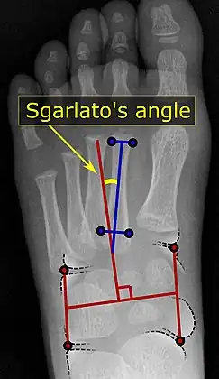 A Sgarlato's angle of more than 15° indicates pigeon toe.[9]