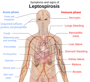A schematic of the human body showing the symptoms and signs of leptospirosis