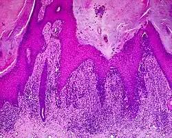 Acral lentiginous melanoma (ALM)
