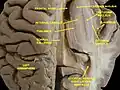 Ventricles of brain and basal ganglia. Superior view. Horizontal section. Deep dissection.