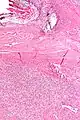 Solitary fibrous tumor - low magnification. H&E stain.
