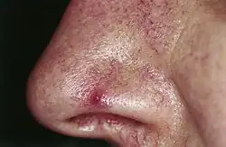 Nevus araneus (spider nevus): in the center of the red lesion a small (1 mm) red papule is visible, surrounded by several distinct radiating vessels. Pressure on the lesion causes it to disappear, however blanching is replaced by rapid refill from the central arteriole when pressure is released.[5]