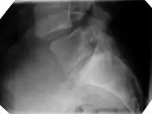 X-ray picture of a grade 1 isthmic anterolisthesis at L4-5