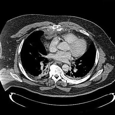 CT scan showing a comminuted sternal fracture.[14]