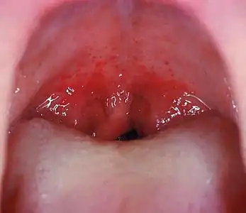Mouth wide open showing the throat Note the petechiae, or small red spots, on the soft palate. This is an uncommon but highly specific finding in streptococcal pharyngitis.[12]