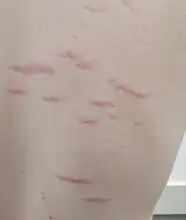 Normal stretch marks on a teenage male's back