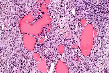 High magnification Struma ovarii