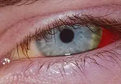 Same as prior after four weeks