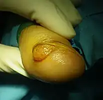 Subungual exostosis (2/3)