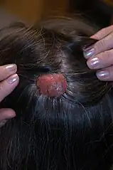 An example of a syringocystadenoma papilliferum