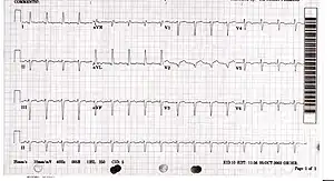 ECG showing sinus tachycardia and non-specific ST and T wave changes from a person with confirmed takotsubo cardiomyopathy