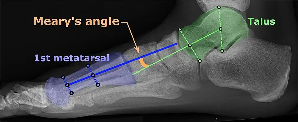 Same lateral X-ray showing the measurement of Meary's angle, which is the angle between the long axis of the talus and first metatarsal bone.[14] This example is slightly convex downward. An angle greater than 4° convex upward is considered pes cavus.[14]