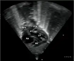 Echocardiogram in transposition of the great arteries. This subcostal view shows the left ventricle giving rise to a vessel that bifurcates, which is thus identified as the pulmonary artery. Abbreviations: RA=right atrium, RV=right ventricle, LV=left ventricle, PT=pulmonary trunk, LPA and RPA=left and right pulmonary artery.