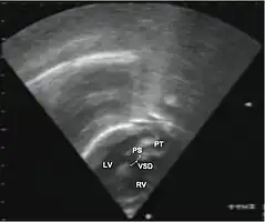 Echocardiography of a complex transposition with a ventricular septal defect and pulmonary stenosis. Abbreviations: LV and RV=left and right ventricle, PT=pulmonary trunk, VSD=ventricular septal defect, PS=pulmonary stenosis.