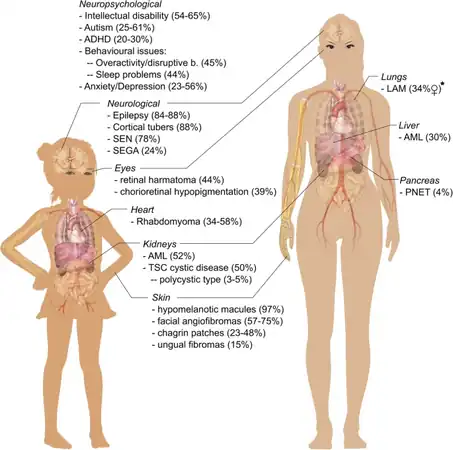 Overview of clinical organ manifestations in Tuberous sclerosis[8]