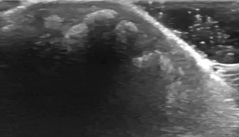 tumorous calcinosis over a malleolus in ultrasound