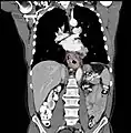 Contrast CT scan showing an esophageal tumor (coronal view)