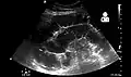 Small bowel obstruction on ultrasound.[15]