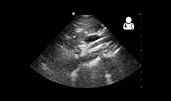 Ultrasound showing SMA syndrome[19]