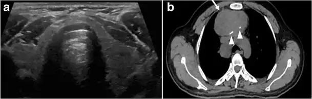Fig. 4. A 45-year-old male patient presented with anterior mediastinal metastatic PTC lesions and occult primary on imaging. Histopathology examination of the resected thyroid gland revealed micro-foci of PTC; the largest, in the isthmus, measured 4&nbsp;mm. a transverse greyscale ultrasound of the thyroid demonstrates homogeneous gland with normal echogenicity and size. No focal lesion or micro-calcifications. b Non-enhanced CT scan obtained as part of PET/CT examination shows a heterogeneous, large, relatively dense anterior mediastinal mass (white arrow) with peripheral calcification (arrowheads). Thyroid gland has normal CT appearance with no abnormal FDG uptake (not shown).