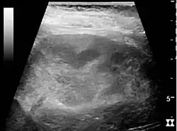 Figure 26. Acute pyelonephritis with increased cortical echogenicity and blurred delineation of the upper pole.