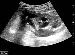Figure 16. Hydronephrosis with dilated anechoic pelvis and calyces, along with cortical atrophy. The width of a calyx is measured on the US image in the longitudinal scan plane, and illustrated by '+' and a dashed line.