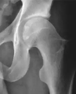 Radiograph of a cam type impingement.