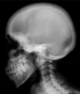 Ground glass density of the skull.[17]