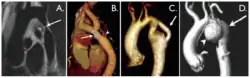 Aortic coarctation using different imaging techniques[10]