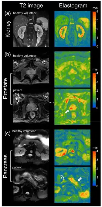 Tomoelastography of Kidney Prostate and Pancreas