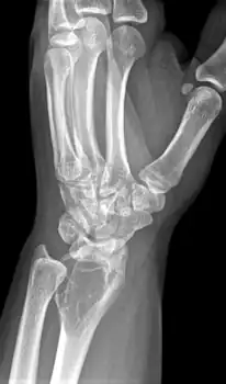 Side view of same wrist