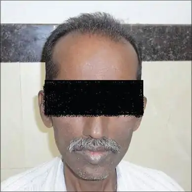 Iron overload in a 48 year old from India[10]