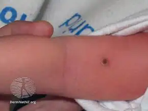 Langerhans cell histiocytosis[15]