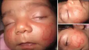 Tinea faciei on both cheeks