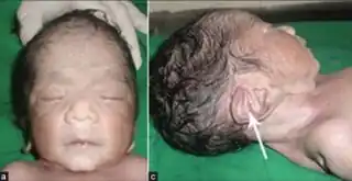 A child with a flattened nose and low set ears due to Potter sequence[4]