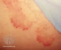 Tinea cruris in a female