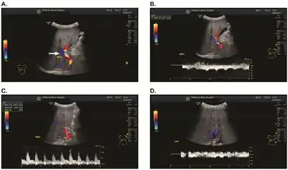 a-d) Individual who developed VOD/SOS after HCT for acute myelogenous leukemia