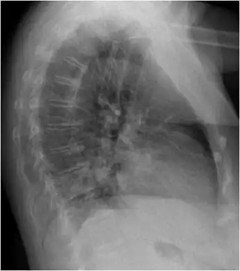 Chest X-ray shows patchy retrocardial infiltrate.