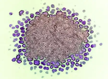 Transmission electron micrograph of numerous HIV-1 virus particles purple[20]