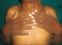 AN and plantar keratoderma in bladder cancer