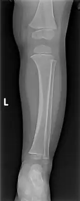 Accidental or innocent toddler fracture/frontal