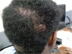 AKN with folliculitis decalvans