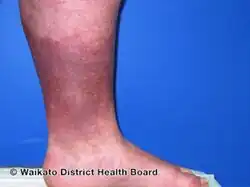 Lipodermatosclerosis