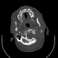 Acute on chronic subdural hematoma